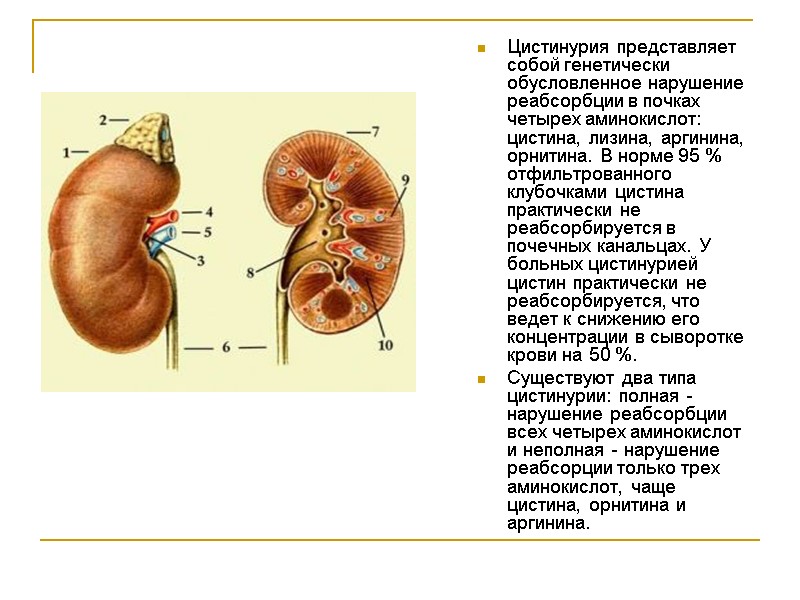 Цистинурия представляет собой генетически обусловленное нарушение реабсорбции в почках четырех аминокислот: цистина, лизина, аргинина,
